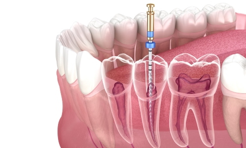 Endodoncia