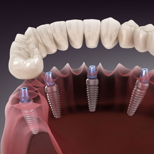 Implantes Implantes