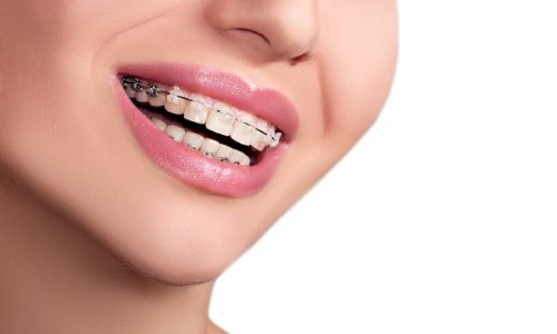 Braquets Braquets