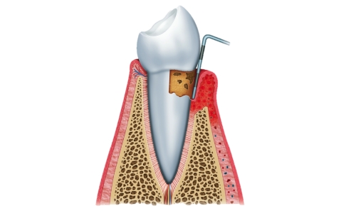 Periodoncia