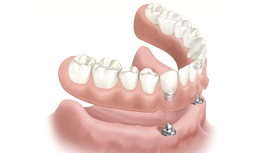 Prótesis Dentales