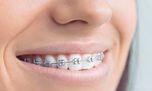 Braquets Braquets