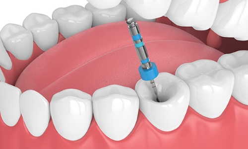 Endodoncia