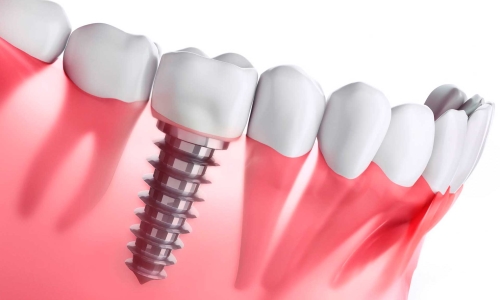 Implantes Implantes