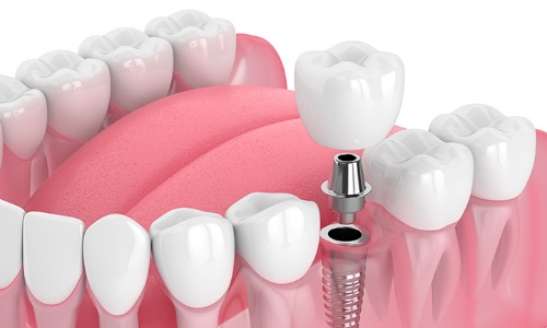 Implantes Implantes