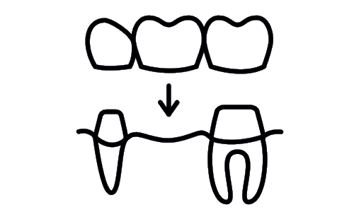 Prótesis Dental